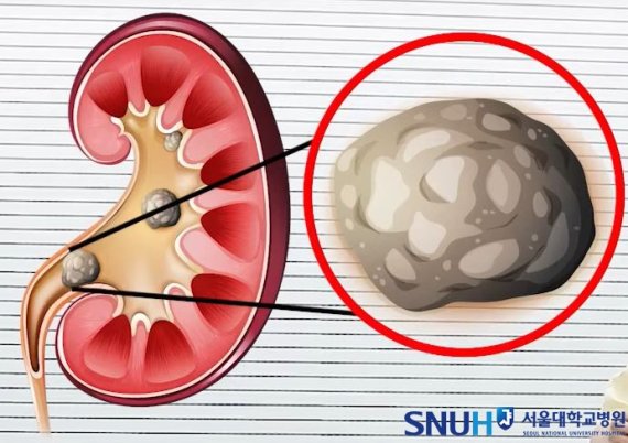 요로결석의 크기가 5mm 보다 작으면 자연배출이 가능하다. 통계적으로 5mm 이하 결석은 약 80% 이상 자연적으로 배출된다. 요로결석의 자연비출을 돕기 위해서는 물을 충분히 마셔서 소변량을 늘리는 것이 필요하며, 통증이 있을 경우 진통제를 복용하며 경과를 지켜봐야 한다. 사진=서울대학교병원