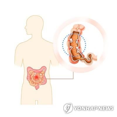 크론병은 면역체계가 비정상적으로 활성화되면서 입에서 항문까지 염증이 발생할 수 있는 만성 염증성 장질환이다. 염증은 장벽 전체에 걸쳐 생길 수 있으며, 띄엄띄엄 깊은 궤양이 나타난다는 점이 특징이다. /연합뉴스