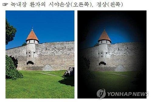 녹내장의 가장 특징적인 증상은 시야가 점점 좁아지는 것이다. 보통 주변부 시야부터 조금씩 좁아지는데, 중심 시력은 유지되기 때문에 환자가 알아차리기 어렵다. 사진=서울대병원