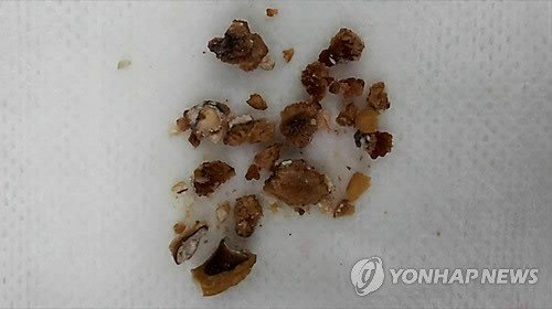 요로결석의 크기가 5mm를 넘으면 자연배출이 쉽지 않아 체외충격파쇄석술을 시행한다. 체외충격파쇄석술은 몸 밖에서 강력한 충격파를 가해 요로결석을 잘게 부수어 소변으로 배출을 용이하게 하는 비수술적 치료법이다. 사진은 실제 요로결석 환자 몸에서 나온 요로결석./연합뉴스