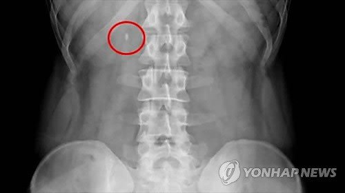 요로결석은 소변이 지나가는 길에 돌이 생기는 질환을 말한다. 매년 30만 명이 넘는 환자가 요로결석으로 인해 병원을 찾으며, 남성이 여성보다 2배 이상 많이 발병한다. 요로결선은 한 번 생기면 5년내 재발률이 50%에 달해 주의가 필요하다. 사진=연합뉴스