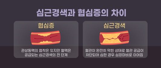 심근경색과 협심증의 차이. 그래픽=게티이미지뱅크