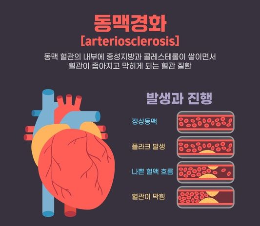 동맥경화. 그래픽=게티이미지뱅크