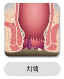 치핵. 사진=보건복지부
