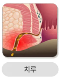 치루. 사진=보건복지부