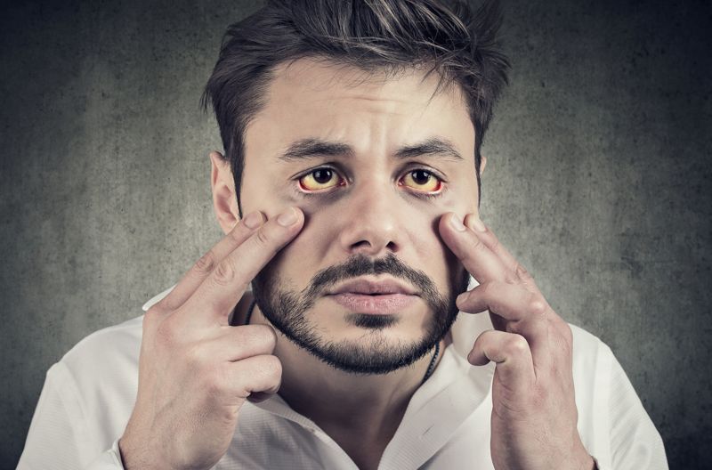 간경변에 의해 간 기능이 저하되면 빌리루빈 색소를 처리하지 못해 피부와 눈 흰자위가 노랗게 변하는 황달 증상이 나타날 수 있다. 사진=게티이미지뱅크