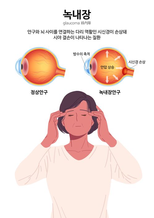 녹내장은 한번 발병하면 완치가 어려워 평생 관리가 필요한 질환이다. 녹내장의 주요 원인은 각막과 수정체 사이에서 산소와 영양분을 공급하는 '방수'라는 액체가 제대로 배출되지 못하면서 안압이 증가하는 것이다. 사진=게티이미지뱅크