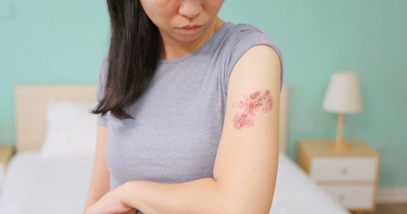 대상포진은 평생 3명 중 1명꼴로 발병하는 비교적 흔한 질환으로 보통 여성 환자가 남성 환자보다 약 1.6배 많다. 특히 50세 이상에서 발병률이 급격히 증가하는 경향을 보인다. 최근에는 2030 젊은 층도 과로와 스트레스, 불규칙한 생활 등으로 면역력이 떨어져 대상포진을 앓는 사례가 적지 않다. /게티이미지뱅크