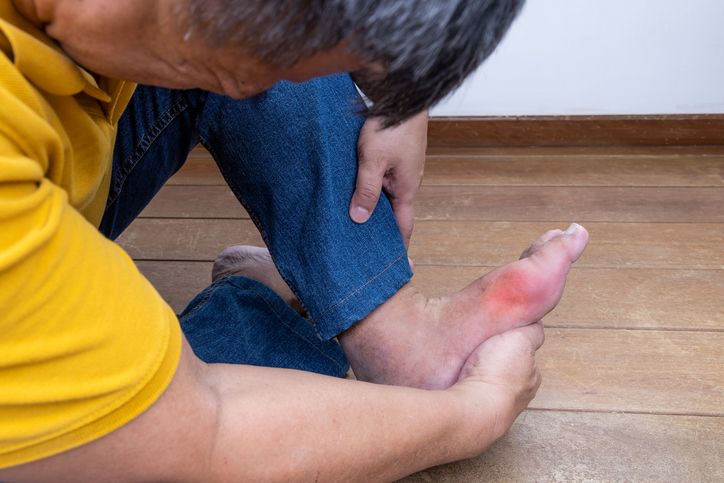 통풍 치료는 급성 발작 치료와 장기적인 요산 관리로 나뉜다. 급성 통풍 발작이 발생하면 안정을 취하고 가능한 신속하게 적절한 치료를 시작해야 한다. 급성 발작 시에는 콜히친, 비스테로이드 항염제, 스테로이드 등의 약물을 복용하면 대부분의 증상은 3~7일 안에 호전된다. /게티이미지뱅크
