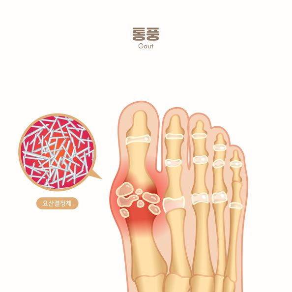 요산은 음식에 들어있는 '퓨린' 단백질이 분해될 때 생성되는 최종 대사 산물이다. 퓨린이 많은 음식을 과다 섭취하거나 체내에서 요산이 과잉 생산되는 경우, 또는 신장 기능 저하 등으로 요산이 제대로 배출되지 못하는 경우에 요산이 체내에 축적된다. /게티이미지뱅크